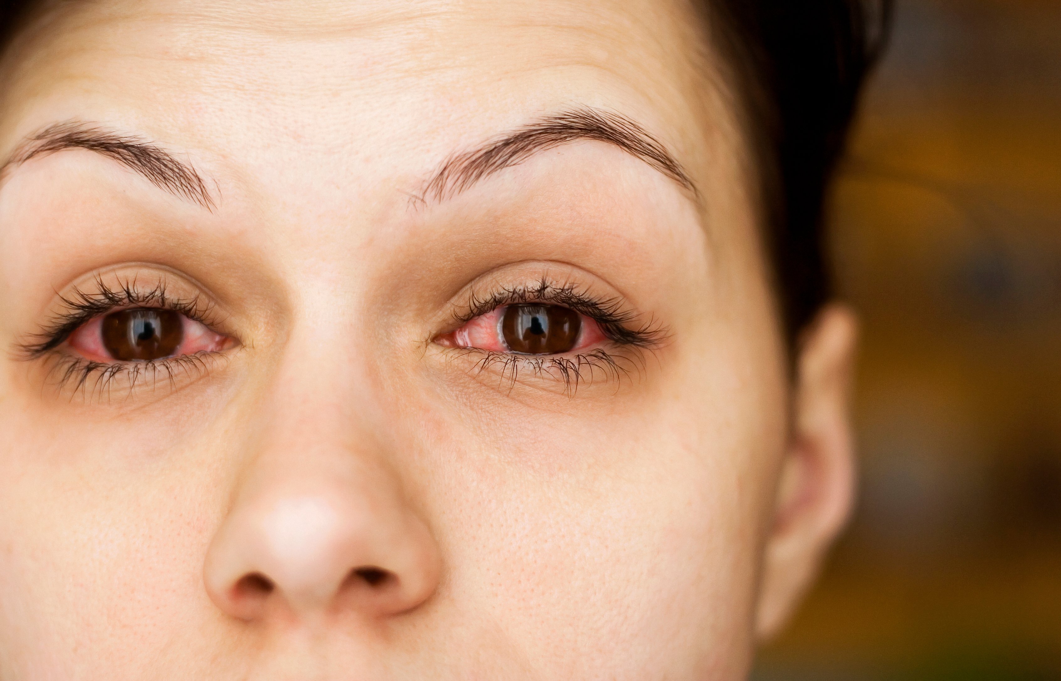 Basic Causes Of Red Irritated Eyes